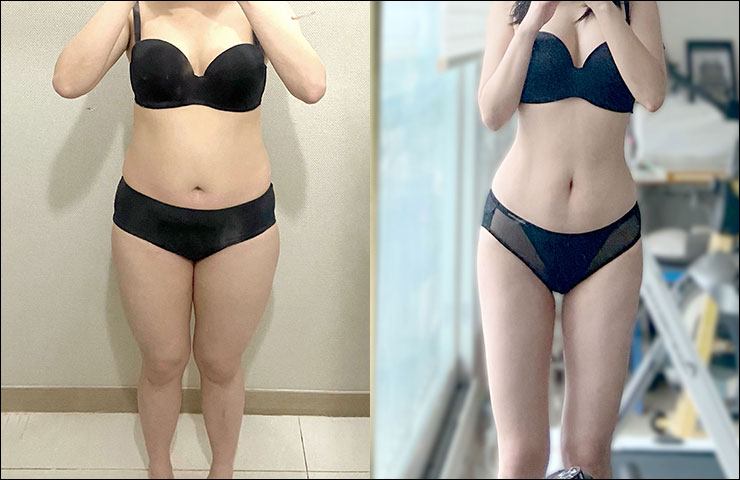 대용량 - 허벅지 전후사진