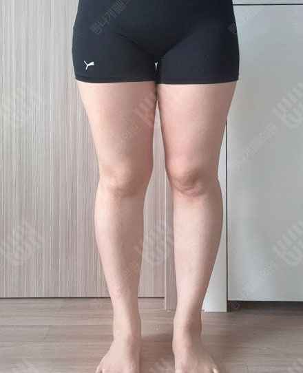 허벅지지방흡입 전