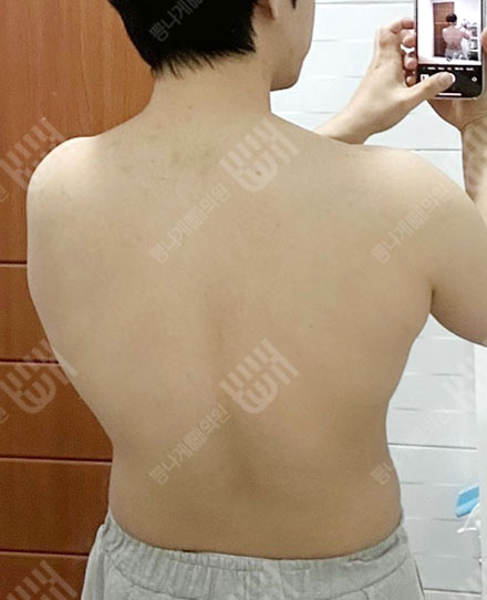 남자등지방흡입1 전