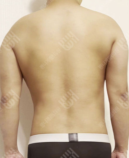 남자등지방흡입2 후
