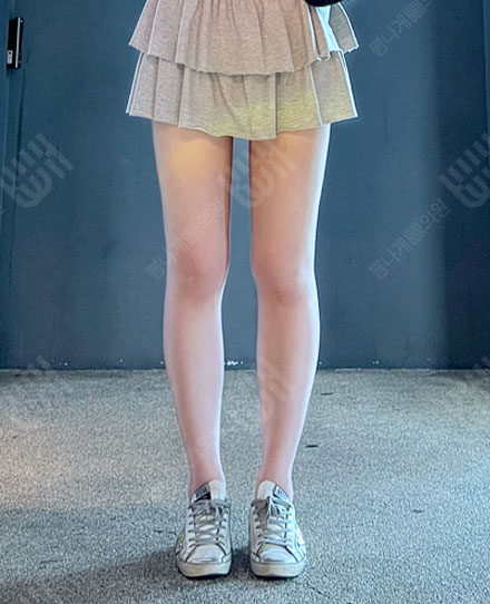 허벅지지방흡입 후