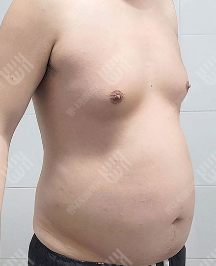 여유증3 전