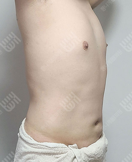 여유증3 후