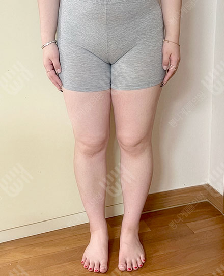 허벅지지방흡입 전