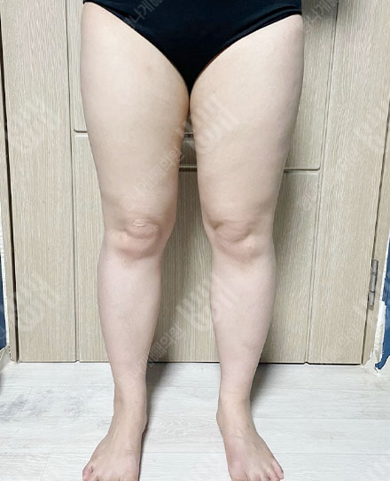 허벅지지방흡입4 전