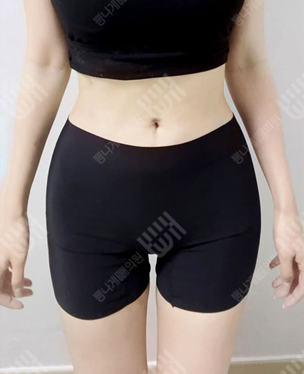 골반지방이식8 후