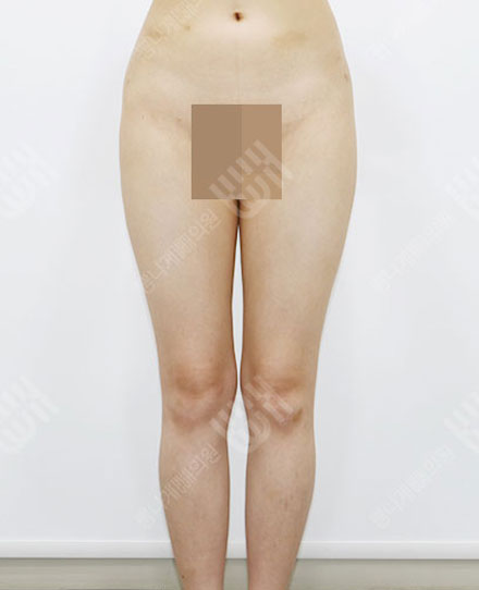 지방흡입재수술6 전