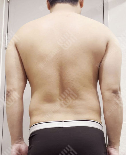 남자등지방흡입2 전