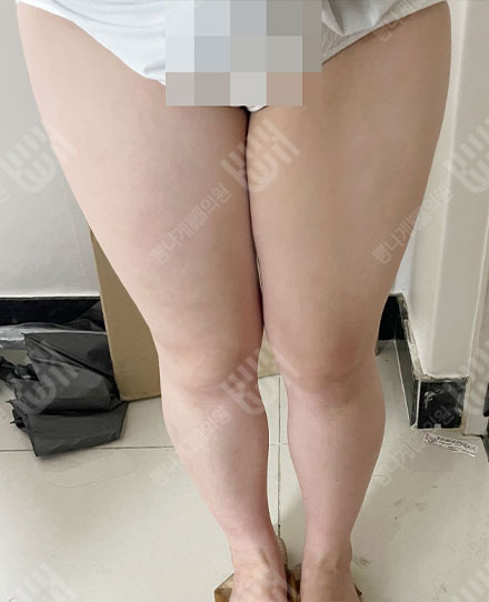 허벅지지방흡입 전