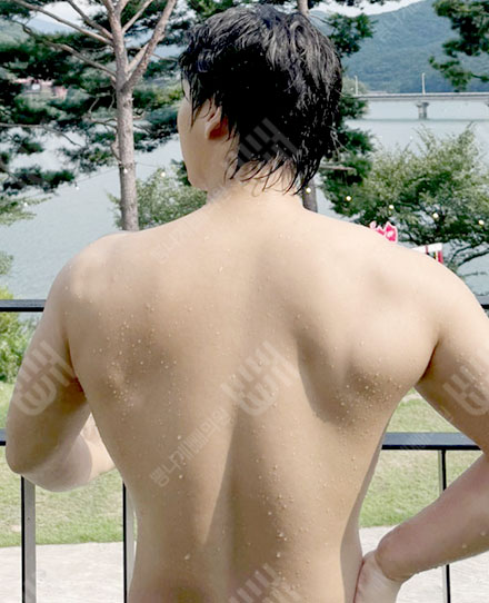 남자등지방흡입1 후
