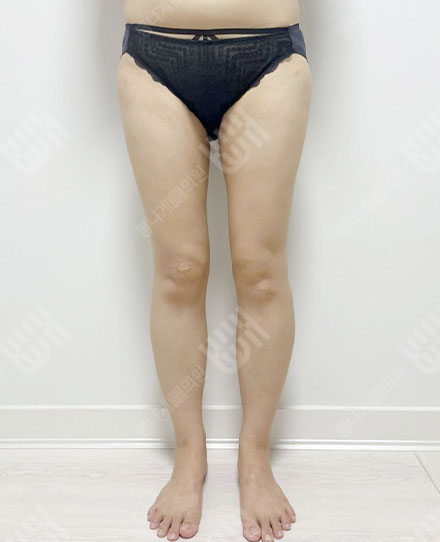 허벅지지방흡입4 후