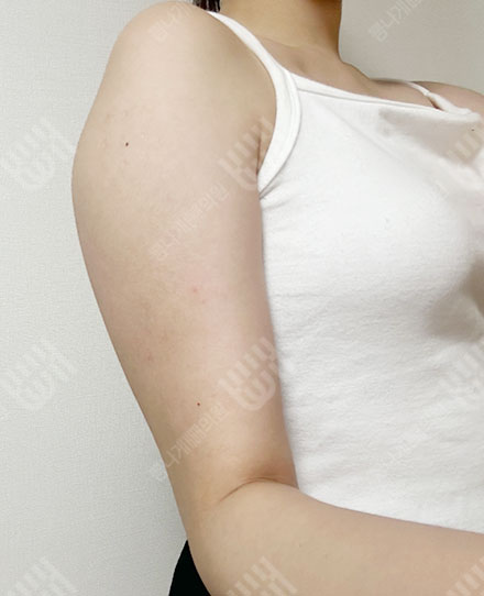팔지방흡입 3 전