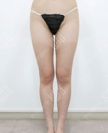 지방흡입재수술 3 전