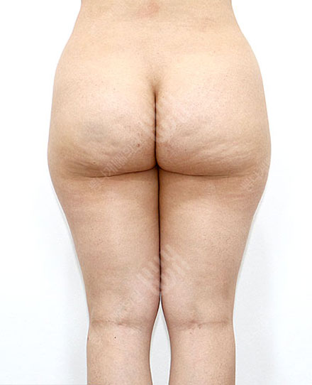엉덩이지방흡입 3 전