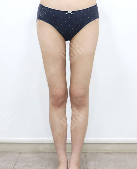 지방흡입재수술 3 후
