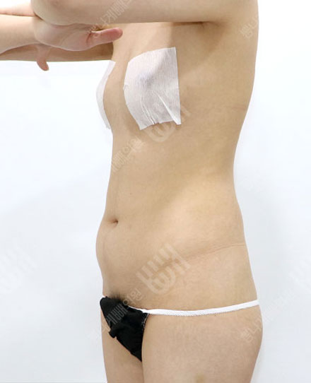 지방흡입재수술 2 전