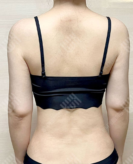등지방흡입4 후