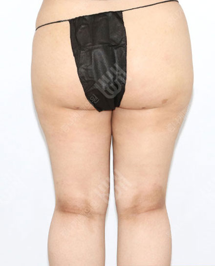 엉덩이지방흡입 후