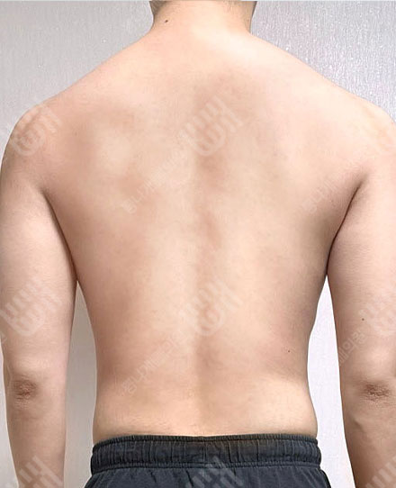 남자등지방흡입3 후