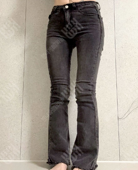 허벅지지방흡입2 후
