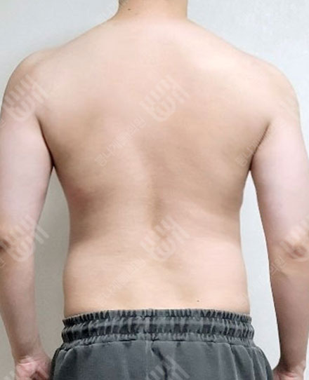 남자등지방흡입3 전