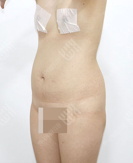 지방흡입재수술5 전