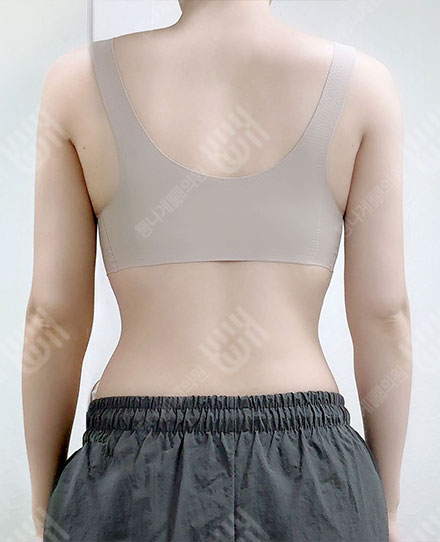 등지방흡입2 후
