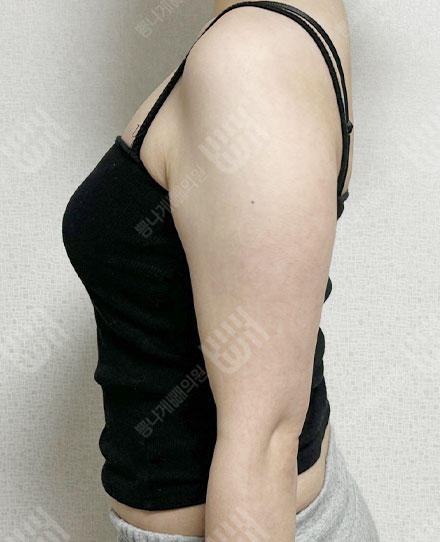 팔지방흡입6 전