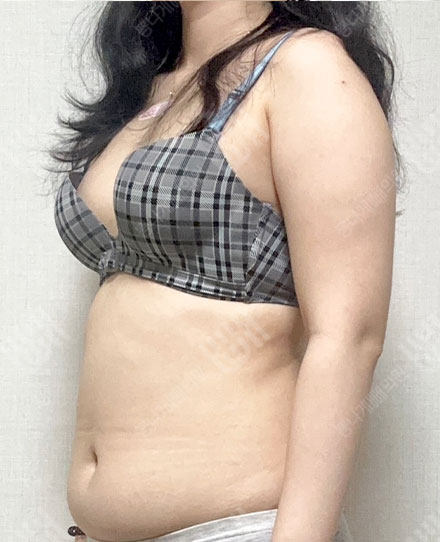 팔지방흡입5 전