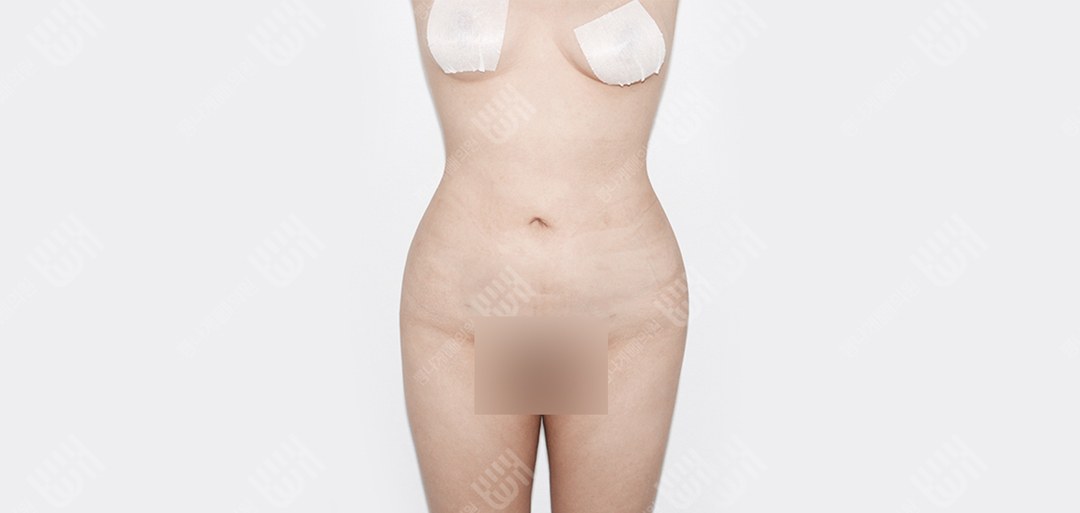 복부지방흡입 수술 후
