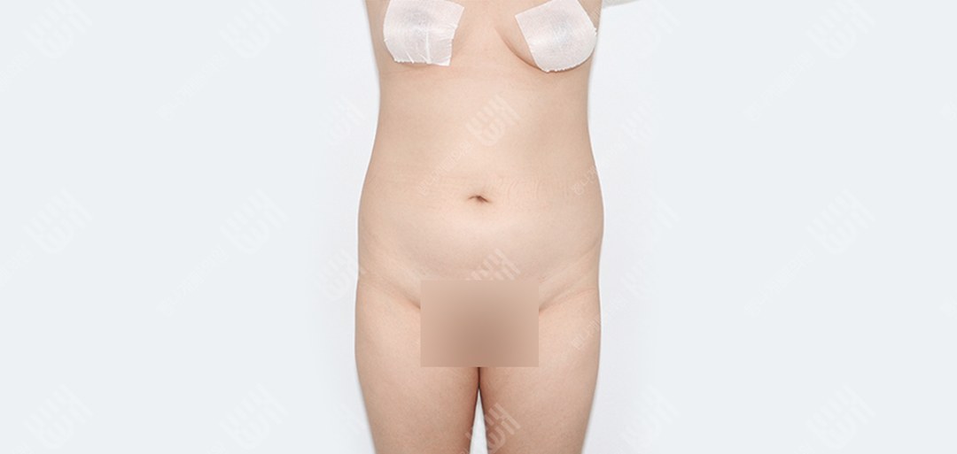 복부지방흡입 수술 전