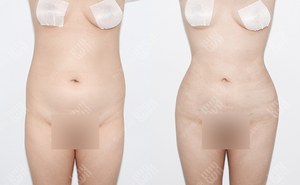 복부지방흡입 165cm / 58kg 전후