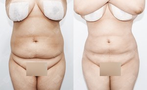 복부지방흡입 163cm / 80kg 전후