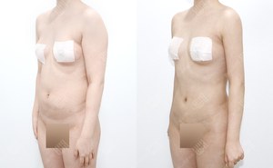팔지방흡입 159cm / 58kg 전후