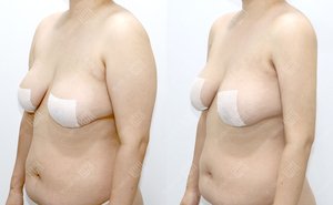 팔지방흡입 170cm / 80kg 전후
