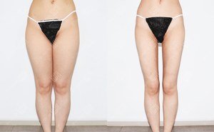 허벅지지방흡입 166cm / 55kg 전후