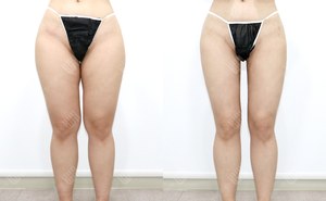 허벅지지방흡입 156cm / 67kg 전후