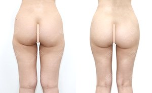 허벅지지방흡입+골반지방이식 155cm / 47kg 전후