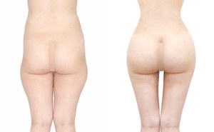 복부지방흡입+허벅지지방흡입+골반지방이식 165cm / 63kg 전후