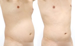 남자 여유증+복부지방흡입 174cm / 73kg 전후