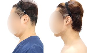 얼굴지방흡입 180cm / 74kg 전후