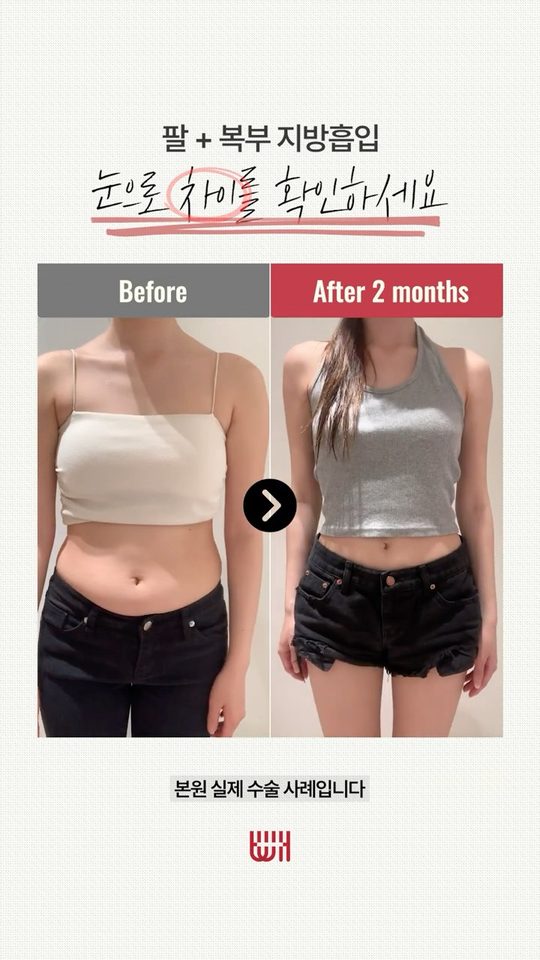 팔+복부 지방흡입 전후