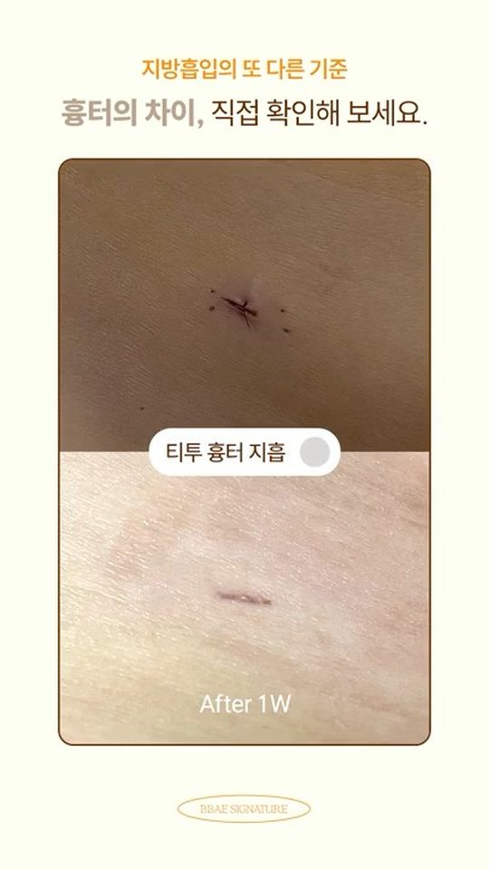 티투흉터 지방흡입