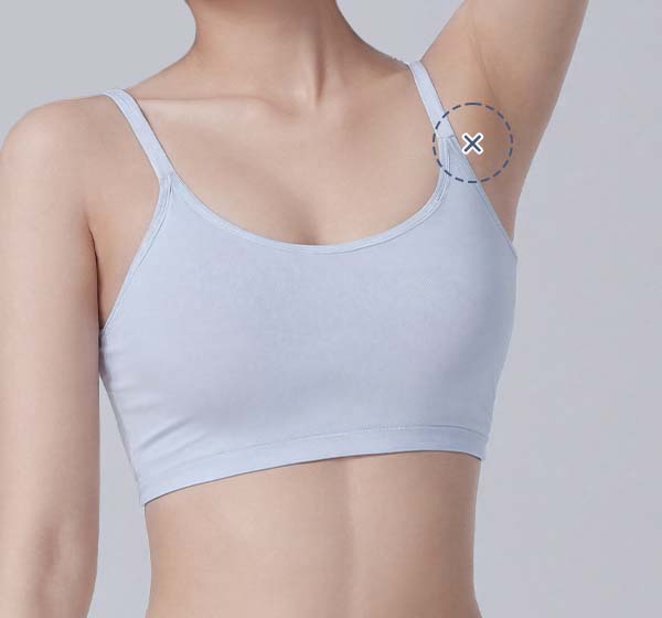 티투흉터지흡 수술 전후 사진