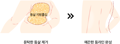 360˚ 흡입으로 완성하는 매끈한 팔뚝 라인