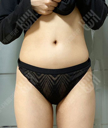 Before: 시술 전