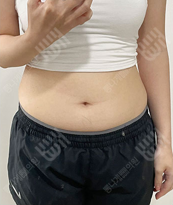 Before: 시술 전