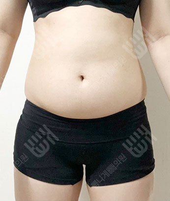 Before: 시술 전