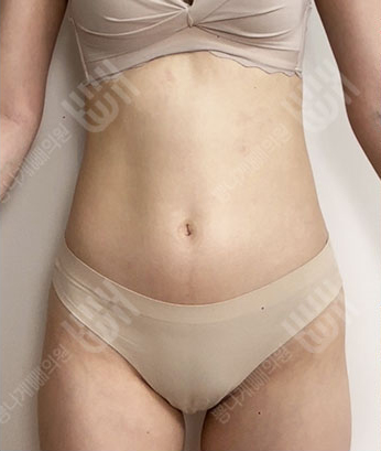 Before: 시술 전