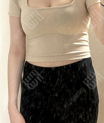 Before: 시술 전